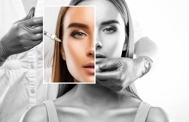 peeling non solo botox