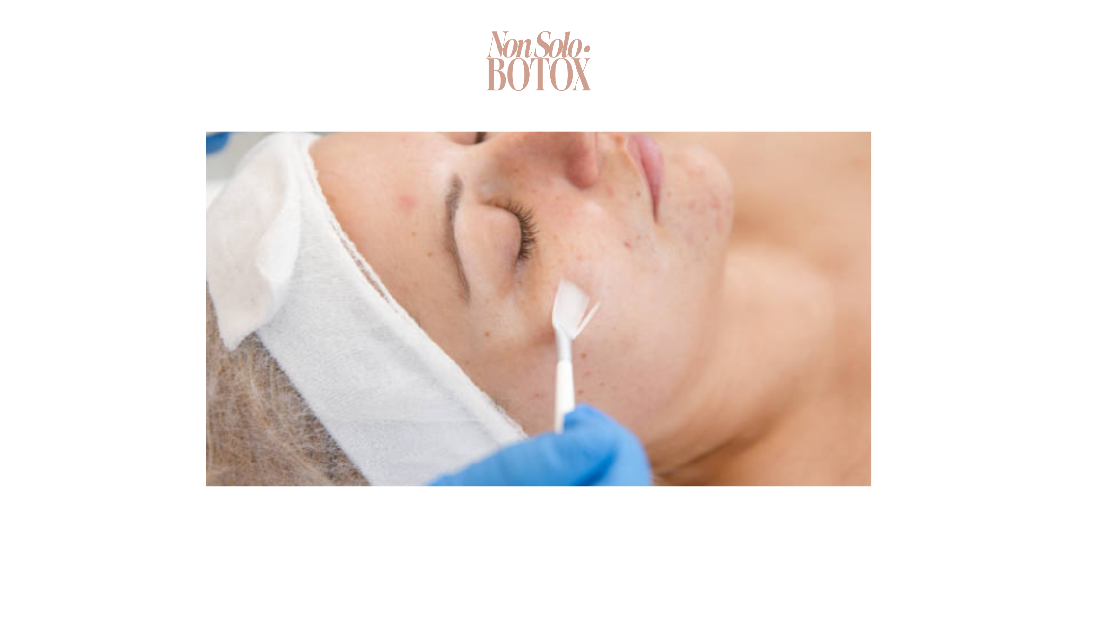 peeling chimico - non solo botox