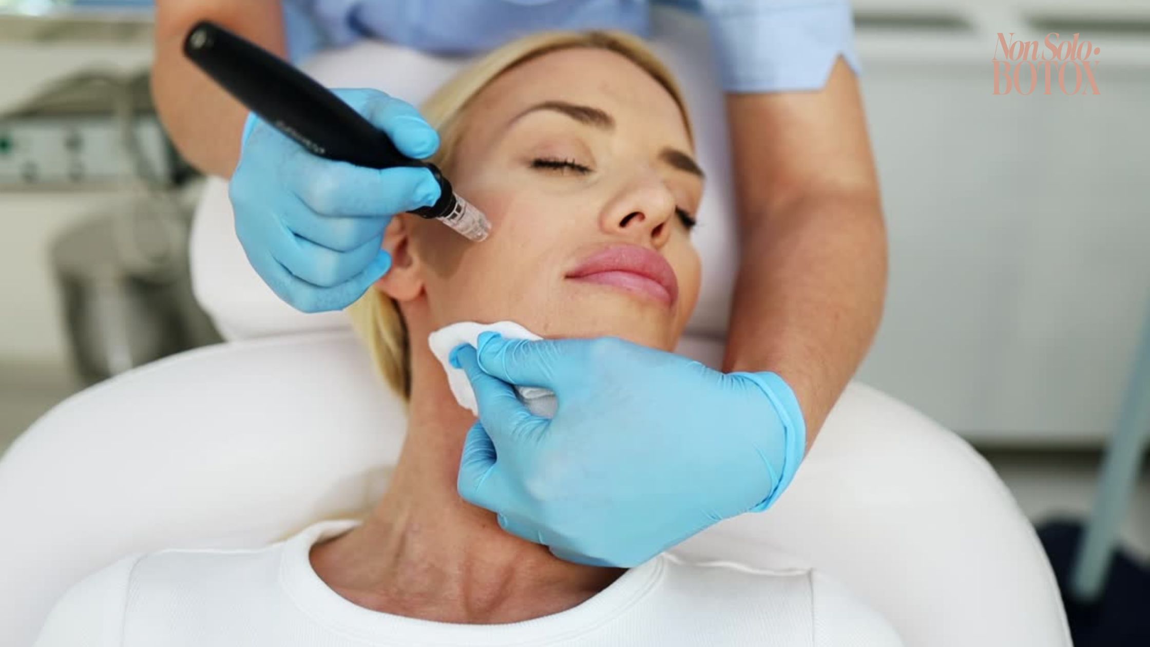 microneedling